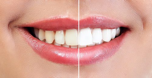 Laser Teeth Whitening, Cleaning Dentists In Abu Dhabi